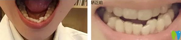 武漢德韓口腔隱適美隱形牙齒矯正前