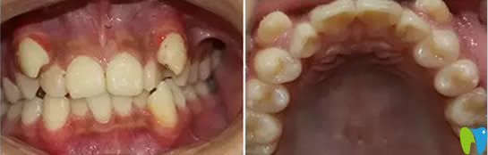 說說13歲的兒子在大連昭鶴口腔做牙齒正畸的效果和經(jīng)歷