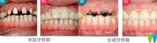 珠海愛思特韓繼新院長牙齒修復(fù)案例