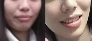 今天下牙套啦，我在東莞好佰年口腔矯正齙牙歷時1045天