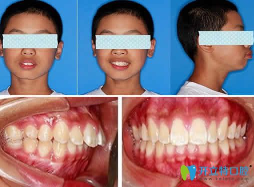 無(wú)錫金貝齊齒科13歲孩子牙齒矯正前的照片