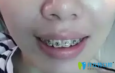 找東莞好佰年口腔張春利做牙齒矯正第88天變化圖