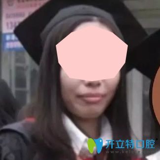 沒(méi)有去東莞好佰年口腔做牙齒矯正前