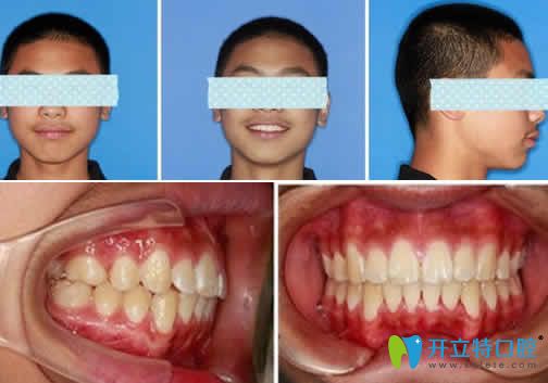 無(wú)錫金貝齊齒科牙齒矯正案例1年效果圖
