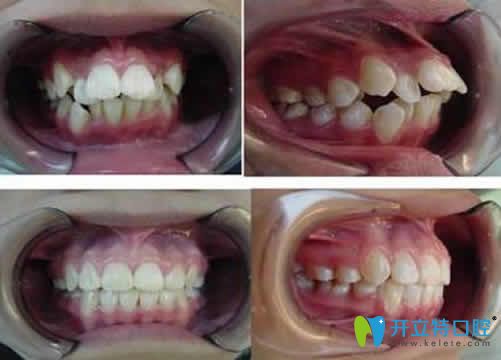 合肥世佳口腔邢沖牙齒矯正案例效果圖 合肥世佳口腔邢沖牙齒矯正案例效果圖