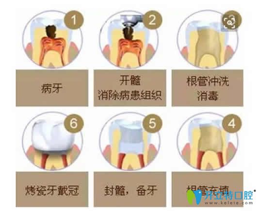做了根管治療后牙疼怎么辦？根管填充后牙疼正常嗎？