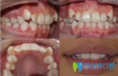 我在寧波壹加壹口腔找茅來(lái)發(fā)主任做牙齒正畸的體驗(yàn)分享