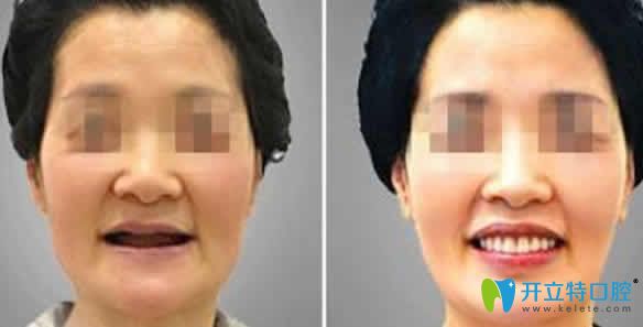 合肥世佳口腔種植牙案例效果圖 合肥世佳口腔種植牙案例效果圖