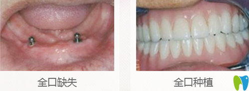 曾凡軍全口牙缺失種植案例前后效果對比圖