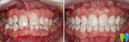 肖丹娜正牙怎么樣？來看顧客正畸后反饋
