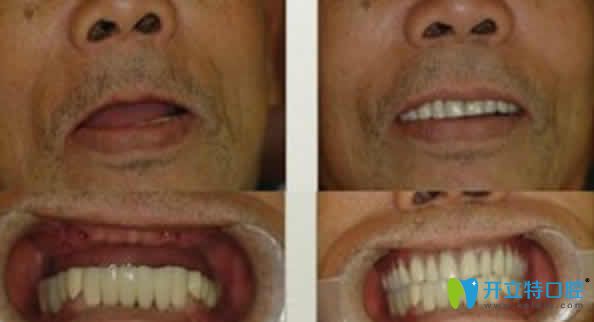 ?？趪趴谇环N植牙案例效果圖