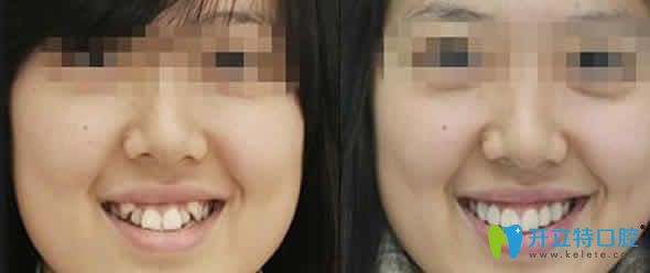 南昌安植雅口腔虎牙矯正前后對比圖 南昌安植雅口腔虎牙矯正前后對比圖