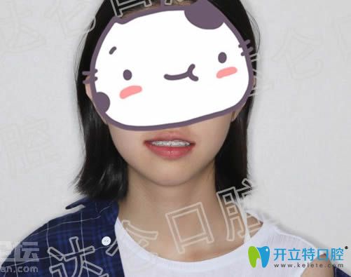 戴半隱形陶瓷牙套12個月后的矯正效果 戴半隱形陶瓷牙套12個月后的矯正效果