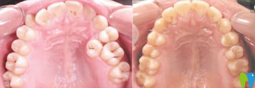 南京佑德口腔傅進(jìn)友主任牙齒正畸效果圖 南京佑德口腔傅進(jìn)友主任牙齒正畸效果圖