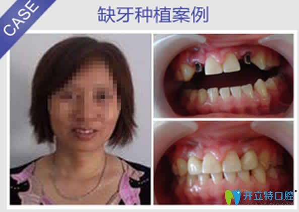 南昌安植雅口腔種植牙案例效果圖 南昌安植雅口腔種植牙案例效果圖
