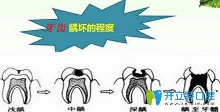 開立特口腔齲齒會影響換牙嗎