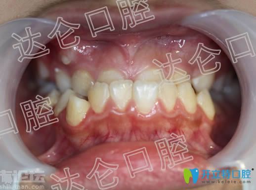 做牙齒矯正前的近照 做牙齒矯正前的近照