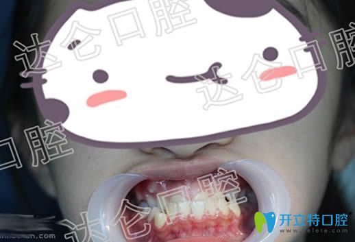杭州達侖口腔地包天矯正案例 看9歲孩子反頜矯正效果怎么樣