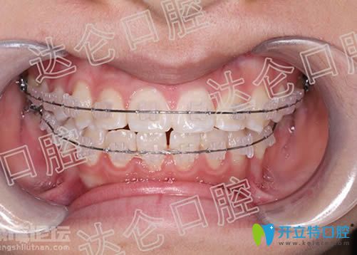 在<!--<i data=20240703-sp></i>-->口腔做地包天矯正29個月后的近照 在<!--<i data=20240703-sp></i>-->口腔做地包天矯正29個月后的近照