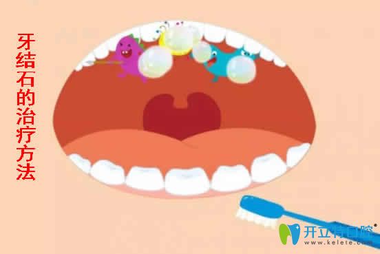 牙結(jié)石的治療方法