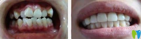 武漢壹加壹口腔成人隱形矯正前后對(duì)比照 武漢壹加壹口腔成人隱形矯正前后對(duì)比照