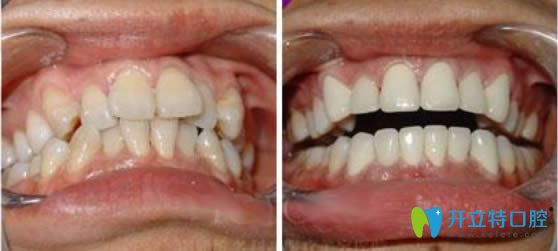 成人牙齒擁擠矯正前后對(duì)比照 成人牙齒擁擠矯正前后對(duì)比照