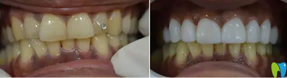 武漢壹加壹口腔牙齒冷光美白對(duì)比效果 武漢壹加壹口腔牙齒冷光美白對(duì)比效果