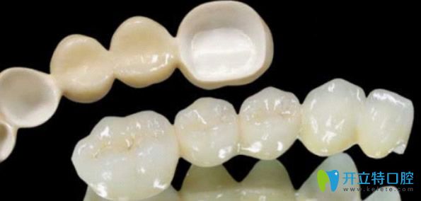 全瓷冠比烤瓷冠價(jià)格貴