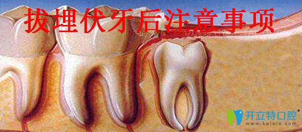 拔埋伏牙的注意事項