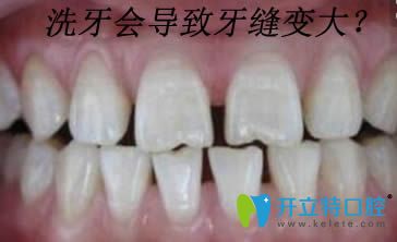 為什么醫(yī)生不推薦洗牙呢,是因?yàn)橄囱罆?huì)導(dǎo)致牙縫變大嗎?
