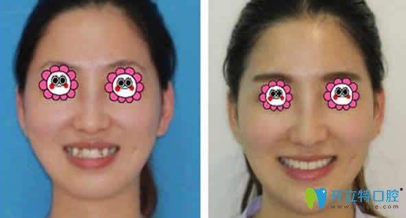 海口國雅口腔虎牙矯正前后對比圖