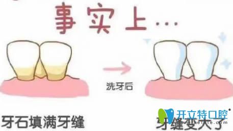 開(kāi)立特口腔網(wǎng)：洗牙會(huì)導(dǎo)致牙縫變大嗎？