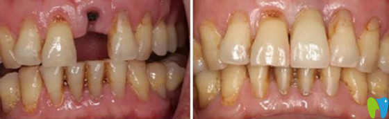 武漢第 一口腔陳東平種植牙案例對比圖