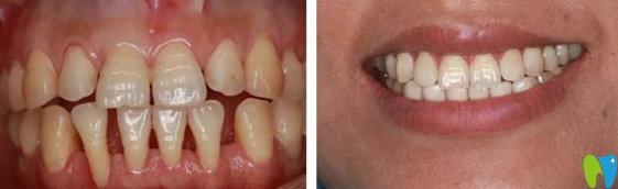 武漢第 一口腔陳東平真人瓷貼面案例