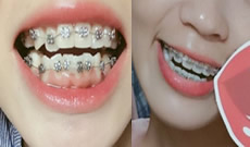 記錄我5個月來在武漢第一口腔醫(yī)院做牙齒正畸的體驗，附圖