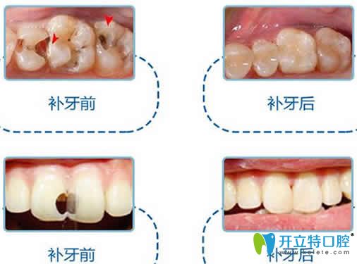 補(bǔ)牙前后對比圖