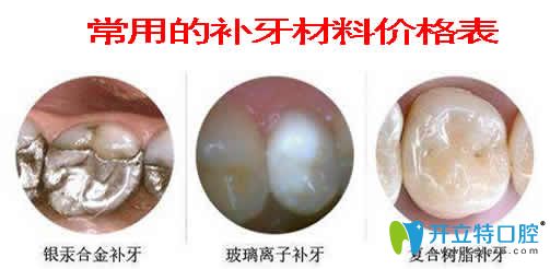 常用的補(bǔ)牙材料價格表