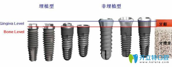 韓國dio種植系統(tǒng)圖片