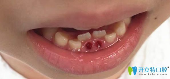 小孩雙排牙會(huì)自動(dòng)歸位嗎