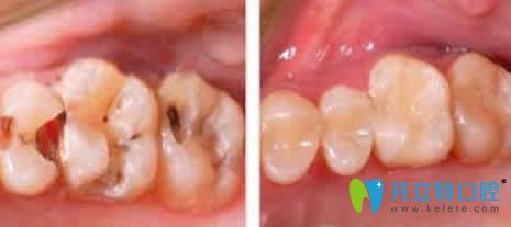 天津愛齒口腔呂春陽根管治療案例效果圖