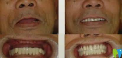 寧波協(xié)禾口腔王昭文院長(zhǎng)全口牙種植案例效果 寧波協(xié)禾口腔王昭文院長(zhǎng)全口牙種植案例效果