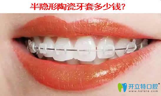 半隱形陶瓷牙套多少錢