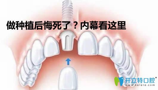 做了種植牙后悔死了?來(lái)看做過(guò)種植牙的人談體會(huì)與個(gè)人經(jīng)歷