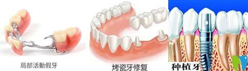 種植牙、活動(dòng)假牙和烤瓷牙哪個(gè)好？看完你就會(huì)明白哦