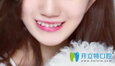 泉州牙博士口腔虎牙矯正第4個(gè)月照片 泉州牙博士口腔虎牙矯正第4個(gè)月照片