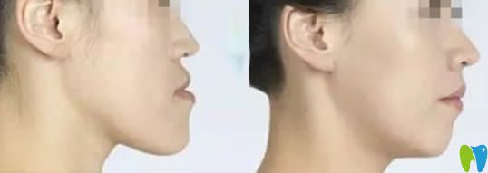 福州維樂口腔郭淑蘋醫(yī)生地包天矯正案例及前后對比照