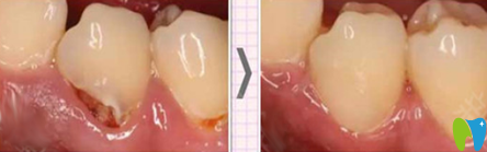 泉州補牙哪家好？來看牙博士口腔補牙治療前后對比案例