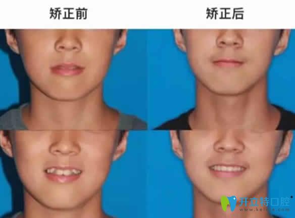 我兒子在無錫金貝齊齒科做虎牙矯正前后對(duì)比照片 我兒子在無錫金貝齊齒科做虎牙矯正前后對(duì)比照片