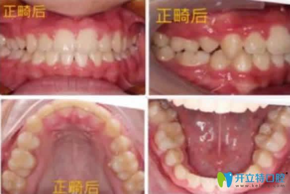 無錫金貝齊齒科給我兒子做虎牙矯正后18個(gè)月的照片 無錫金貝齊齒科給我兒子做虎牙矯正后18個(gè)月的照片