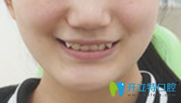 在泉州牙博士口腔做隱形矯正前 在泉州牙博士口腔做隱形矯正前